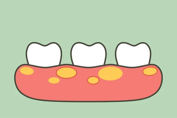 Нездоровые зубы, потому что гингивит или болезнь десен с абсцессом в десне — стоковый вектор