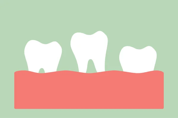 Lös tand, tanden faller ur tandköttet — Stock vektor