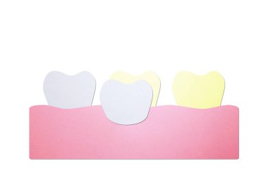 Diş kaplamaları, solmuş dişlere yeni kaplamalar takmak. Çizgi film kağıdı tasarım için şirin bir karakter.