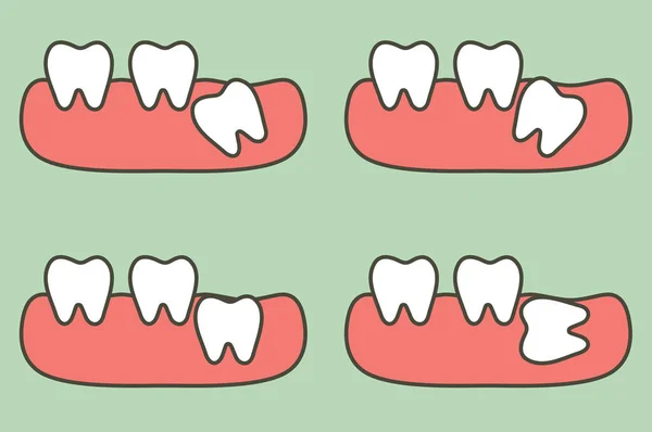 Тип Зуба Мудрості Впливає Інші Зуби Зубний Мультфільм Векторний Плоский — стоковий вектор