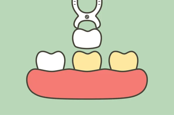 Folheados Dentários Procedimento Instalação Para Clareamento Dental Dentes Desenho Animado —  Vetores de Stock