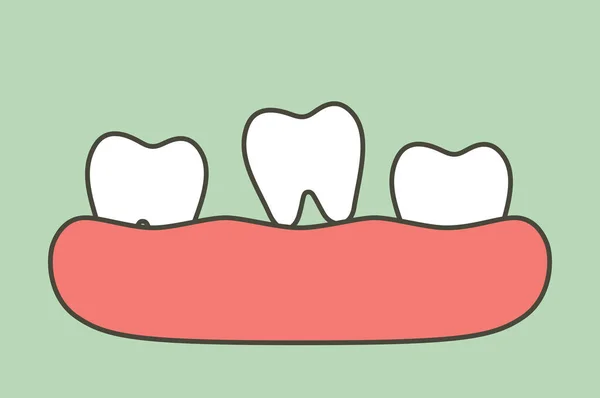 歯がガムから落ちている 歯の漫画のベクトルフラットスタイルかわいいキャラクターのためのデザイン — ストックベクタ