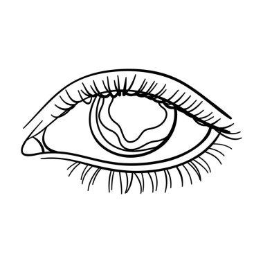 Mavi gözlü bir adam diyabet muzdarip. Yüksek kan şekeri parlak gözlerden. Anahat stili vektör simge stok çizimde diyabet tek simge.