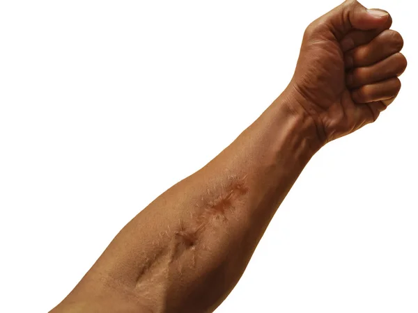 Шрами Шкірі Руки Після Операції Через Нещасний Випадок Футболі Падіння — стокове фото