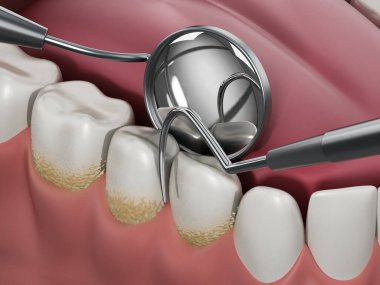 Model üzerinde dişçi aletleri ve diş plaklarını gösteren 3D çizimler. 3d illüstrasyon