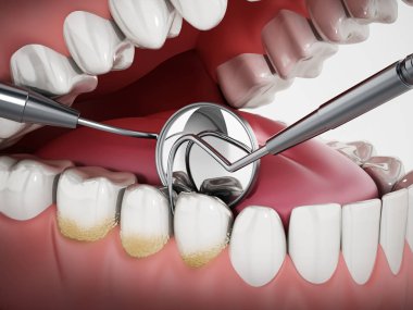Model üzerinde dişçi aletleri ve diş plaklarını gösteren 3D çizimler. 3d illüstrasyon