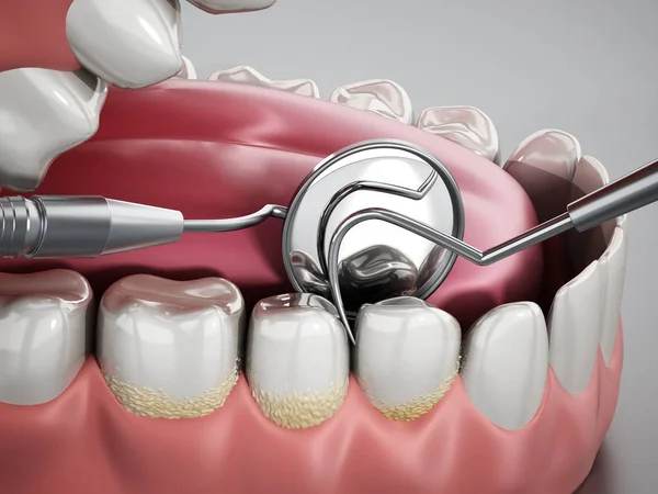 Model üzerinde dişçi aletleri ve diş plaklarını gösteren 3D çizimler. 3d illüstrasyon