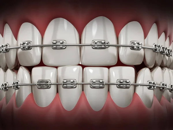 Ilustração mostrando aparelho dentário em dentes retos. Ilustração 3D — Fotografia de Stock