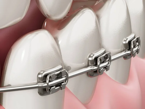 Εικονογράφηση που δείχνει οδοντικά σιδεράκια σε ίσια δόντια. 3D εικονογράφηση — Φωτογραφία Αρχείου