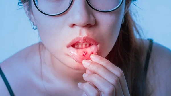 Asian Women Have Aphthous Ulcers Mouth Selective Focus — Stock Photo, Image