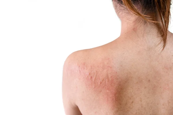 Back Young Asian Woman Have Itchy Allergy Rash White Background — Stock Photo, Image