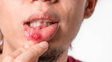 Asian man have aphthous ulcers on mouth on white background, selective focus. clipart