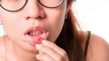 Asian women have aphthous ulcers on mouth, selective focus. clipart
