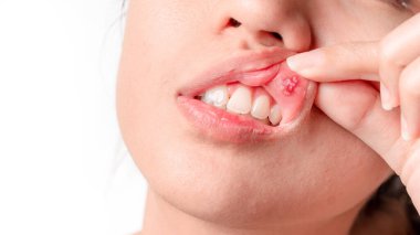 Asian women have aphthous ulcers on mouth on white background, selective focus. clipart