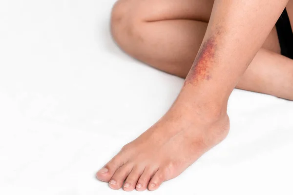 Asian Women Have Bruise Leg Accident White Background — Stock Photo, Image
