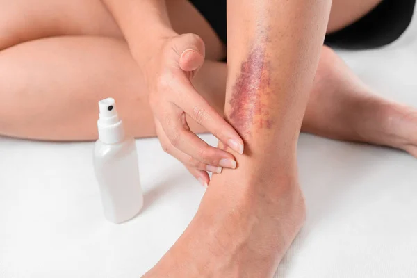 Asyalı kadınların bacakları kazadan dolayı morarır ve beyaz arka planda cildine ilaç spreyi sıkarlar..