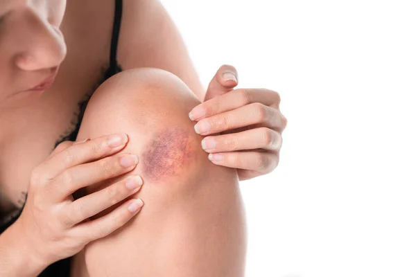 Asian Woman Have Bruise Knee Touch Her Knee Accident White — Stock Photo, Image