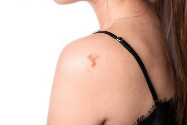 Donne Asiatiche Hanno Cicatrice Cheloide Sulla Spalla Sfondo Bianco Dermatologia — Foto Stock