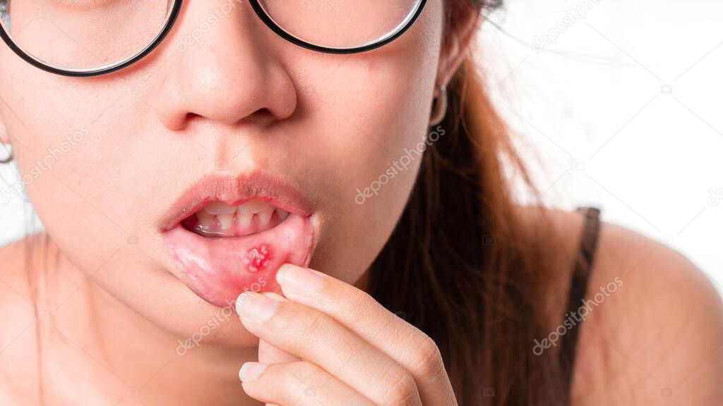Asian women have aphthous ulcers on mouth, selective focus.