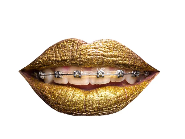 Golden metallized female lips with braces — Stock Photo, Image