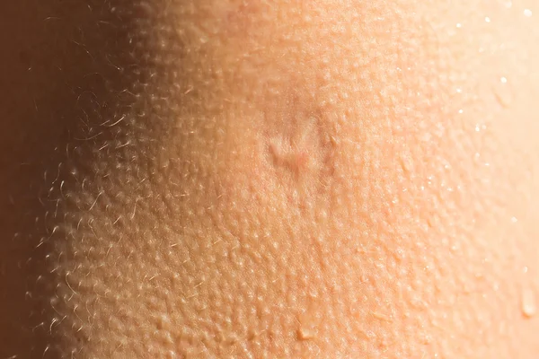 Ουλή στο ανθρώπινο δέρμα — Φωτογραφία Αρχείου