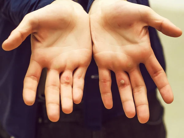 Hands with blister and callus — Stock Photo, Image