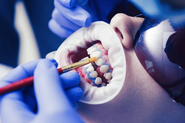 Close-up portret pacjentki u dentysty w klinice. Hollywood smile licówki. Dentysta w jednorazowych uniform w Nowoczesna Klinika stomatologiczna. — Zdjęcie stockowe
