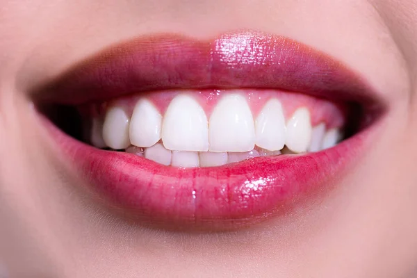 Lachende vrouwenmond met grote tanden. Perfecte lach na het bleken. Tandheelkundige verzorging en bleken van tanden. Gezonde glimlach, smaling. — Stockfoto