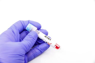 Mikrobiyolog ya da tıp çalışanı elin mavi eldivenli ve kan testinde H1N1 pozitif çıktı. H1N1 Pozitif kavram