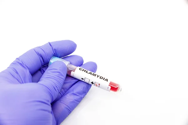 Closeup of microbiologist or medical worker hand with blue surgical gloves marking blood test result as positive for the chlamydia. Chlamydia Positive concept