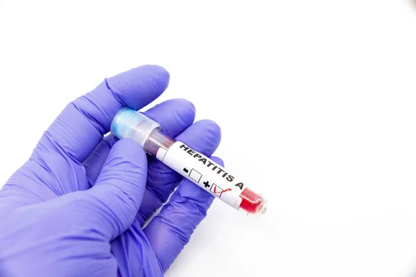 Mikrobiyolog ya da tıp çalışanı elinin mavi eldivenli hali kan testinde hepatit A pozitif çıktı. Hepatit A Pozitif bir kavram