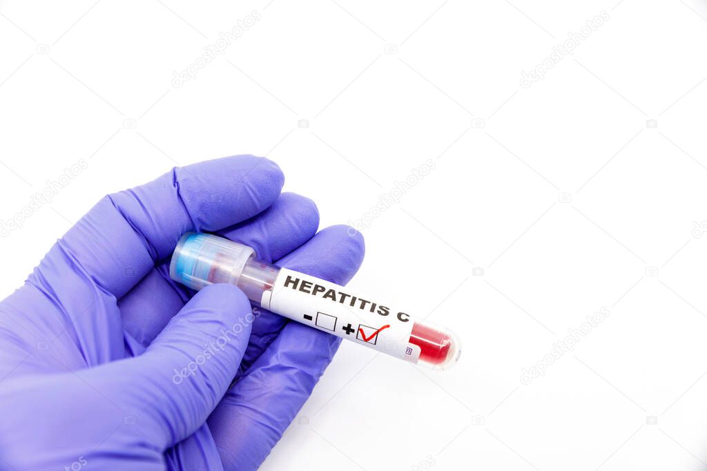 Closeup of microbiologist or medical worker hand with blue surgical gloves marking blood test result as positive for the hepatitis C. Hepatitis C Positive concept