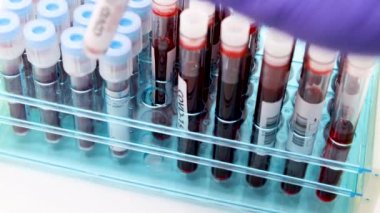 Kan testinin sonucuna göre hızla yayılan yeni Coronavirus için mavi eldivenli mikrobiyolog ya da tıp çalışanı eli yakından inceleniyor. COVID-19 Pozitif kavram