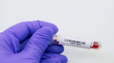 Mikrobiyolog ya da tıbbi çalışanın ellerindeki mavi eldiven ile kan testinin belsoğukluğu için pozitif çıktığını gösteriyor. Belsoğukluğu Konsepti