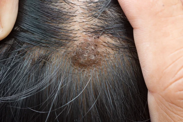 Dermatite dans les cheveux ou maladie de la peau sur la tête — Photo