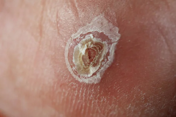 Close up of scab on Skin — стоковое фото