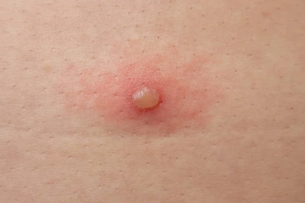 Varicela ou bolha ocorre na pele — Fotografia de Stock