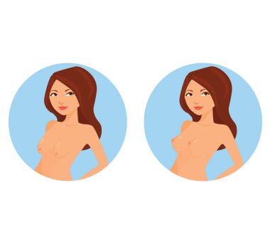 Önce ve sonra kadınların meme kaldırma. Vektör çizim.