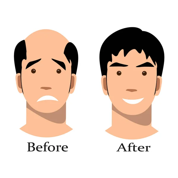 Male baldness pattern stages set. — Stock Vector