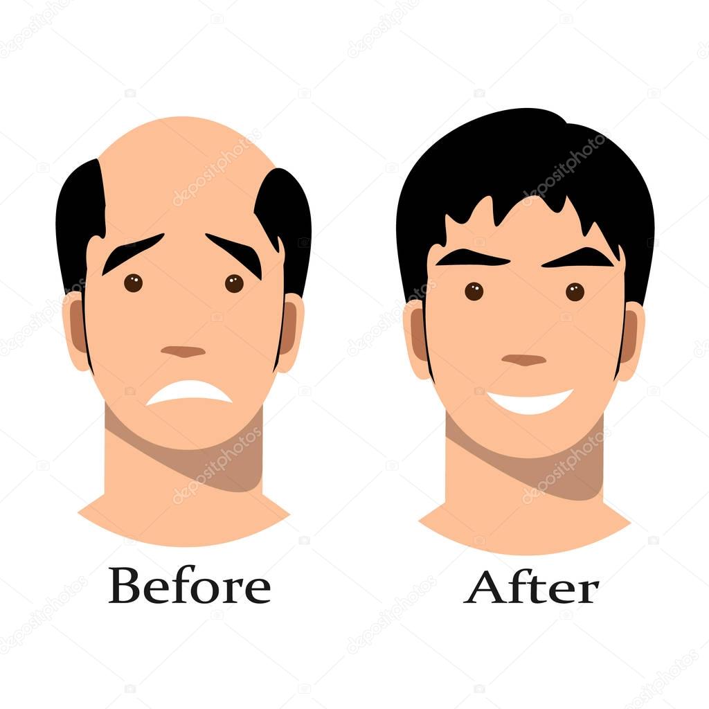 Male baldness pattern stages set.