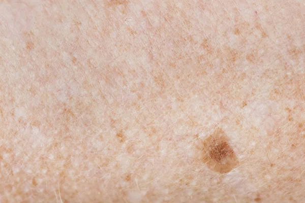 Closeup Φακιδωμένος Δέρμα Του Ανθρώπου — Φωτογραφία Αρχείου