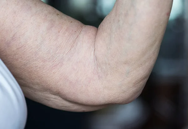 Close Van Losse Ouderen Arm — Stockfoto