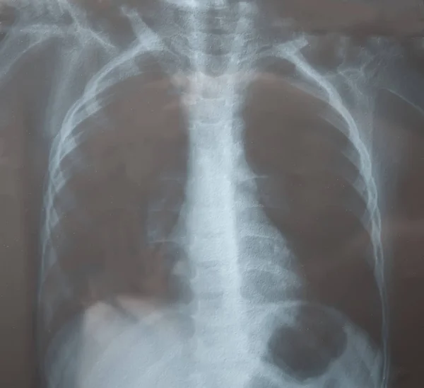 Просмотр детской рентгеновской пленки, сделанной для исследования легких. Пневмония . — стоковое фото