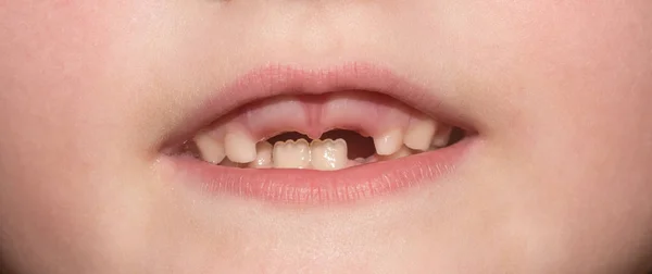 Sonrisa desdentada de cerca. Niño que falta dientes delanteros, se caen del primer diente. Pequeño niño sonriente, su primer bebé leche o diente temporal caen, boca abierta. Hada de los dientes. Dientes de leche sanos —  Fotos de Stock