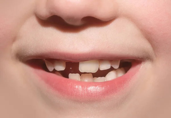 Bocca infantile del bambino senza dente lattiginoso anteriore. Sorriso sdentato. Un bambino ha perso il dente anteriore. Fatina dei denti. Odontoiatria dediatrica infantile, cure dentistiche, andare dal dentista. Frank spensierato sorriso sereno — Foto Stock