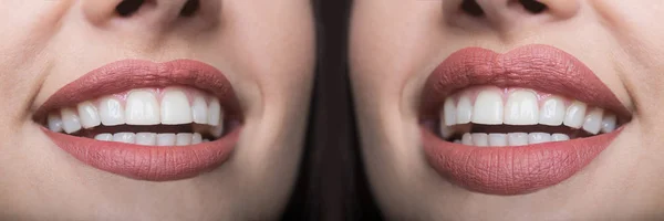 Lip filler injections before and after. Lips Fillers and botox injections. Lip augmentation. Beautiful Perfect Lips. Sexy Mouth close up. Sexy plump lips after filler injection and syringe injection