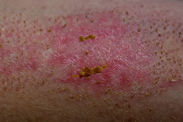 Skin ailment or disease closeup. Wound on the skin heals, crusts. Human body with dermatitis. Atopic Dermatitis, allergic to chemicals, Itchy sick skin lesions from allergies. Dermatologist job injury