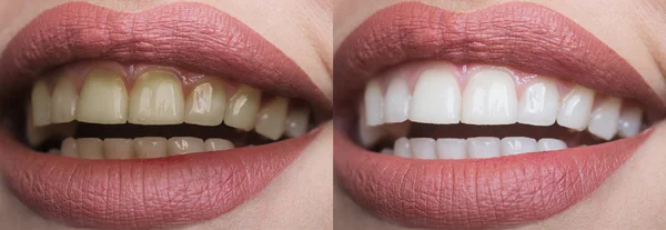 Blanqueamiento dental en el dentista. Concepto de estomatología y clínica dental. Dientes antes y después. Sonrisa de diente blanco. Dientes blancos y amarillos, limpieza de placas en los dientes. Blanqueamiento de pasta dental, dientes sanos — Foto de Stock