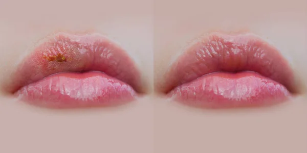 Healthy and sick female lips, closed mouth before and after illness. Care for the lips, herpes on the lips. Herpes on the lip close up macro, part of woman's face, beauty and healthy concept — Stock Photo, Image