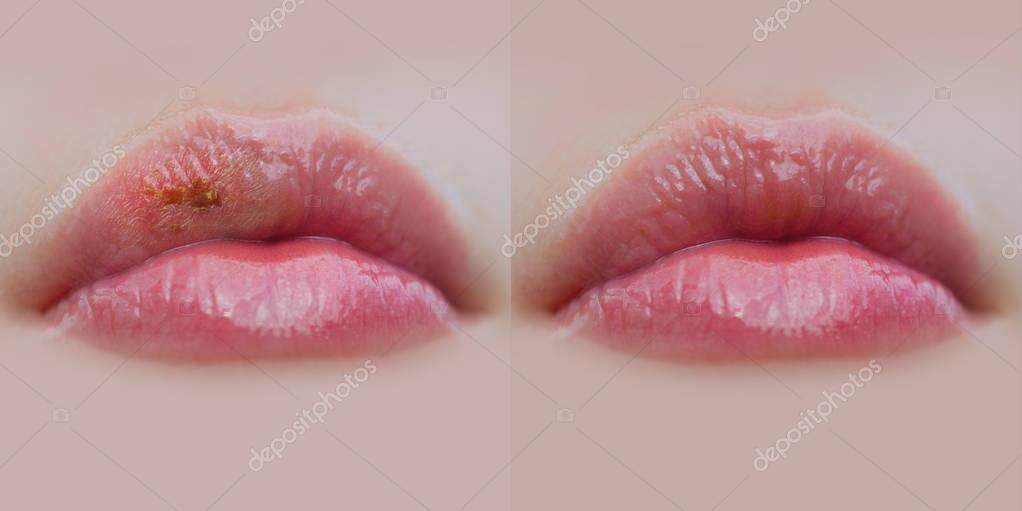 Healthy And Sick Female Lips Closed Mouth Before And After Illness